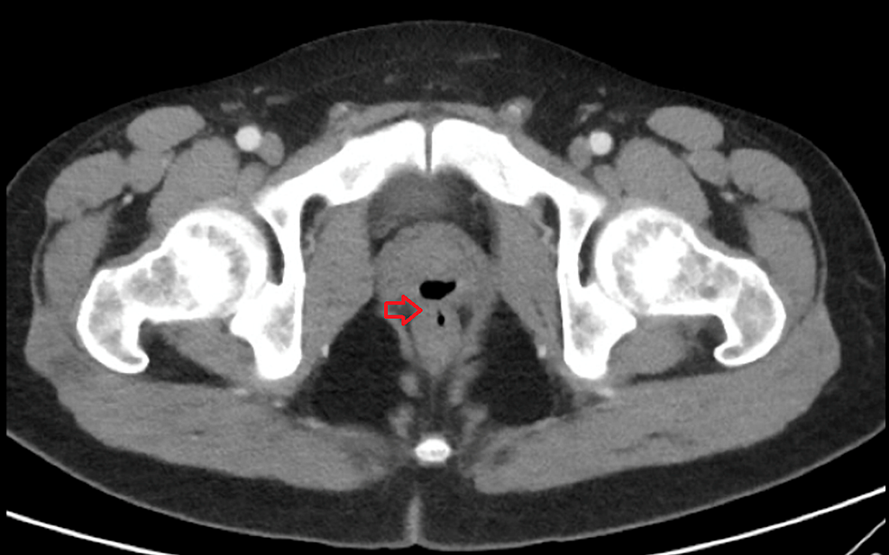 CT scan showing gas-filled structure in prostrate